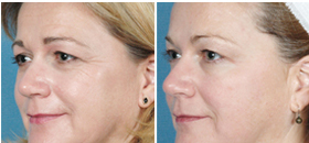Elos Refirme Skin Tightening