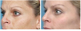 Elos Photo Rejuvenation Facials